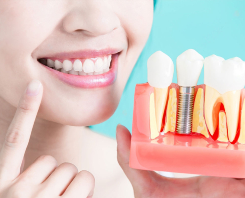 dental-implant-01