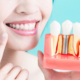 dental-implant-01